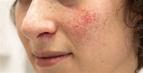 Rosacea is a skin condition that results in redness and noticeable blood vessels in the face. What is Rosacea? - SLMA