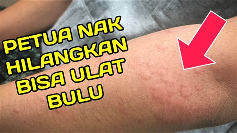 Pelbagai kaedah terbaik hilangkan masalah gegata yang menyeksakan anda! PETUA NAK HILANGKAN BISA ULAT BULU GATAL-GATAL - YouTube