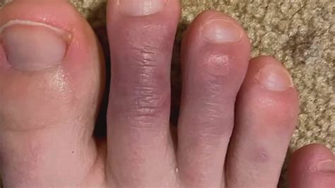 Covid toes are among the more commonly reported dermatologic manifestations. What are COVID toes? - YouTube