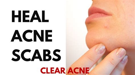 Causes of scabs in nose & how to heal them fast. HOW TO HEAL ACNE SCABS - YouTube
