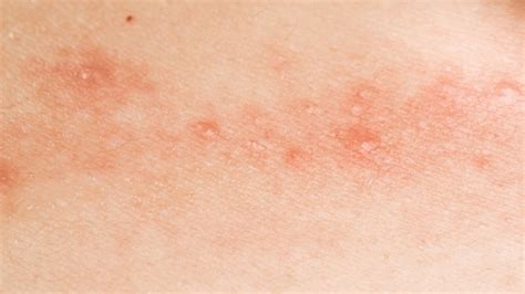 Contact dermatitis causes a bumpy rash that can be itchy and otherwise uncomfortable. 15 Home Remedies For Itchy Armpit Rash - Home Remedies Blog