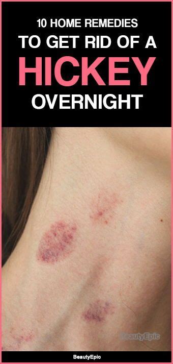 See full list on 54health.com Top 10 Easy Ways to Get Rid of a Hickey Overnight ...