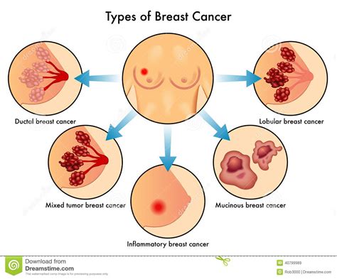 3le malade confronté au cancer craint la perte de son intégrité corporelle, la déchéance et la mutilation de son corps. Types of Breast Cancer stock image. Image of lobes, cancer ...