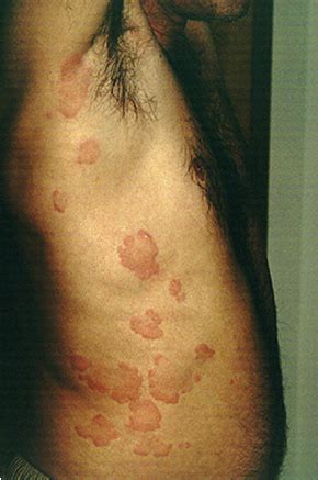 Use them in commercial designs under lifetime, perpetual & worldwide rights. Eastside Family Health Center: The Rash of Hives