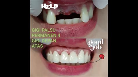 Berikut gambar lucu berbahasa jawa paling ngakak. Terbaru 27+ Gambar Lucu Gigi Ompong