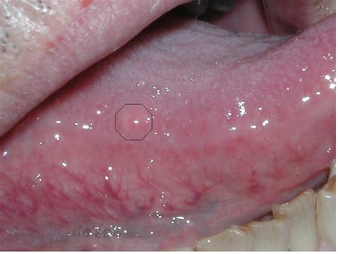 The lump may be white in color and look like an ulcer. Oral Cancer. Causes, symptoms, treatment Oral Cancer