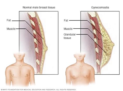 Males have small amounts of breast tissue, which does not develop during puberty. Enlarged breasts in men (gynecomastia) - Symptoms and ...