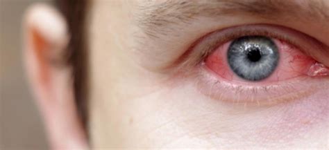 Posterior uveitis affects the back part of the eye. Autoimmune Eye Disease Uveitis - Astigmatism Glaucoma ...