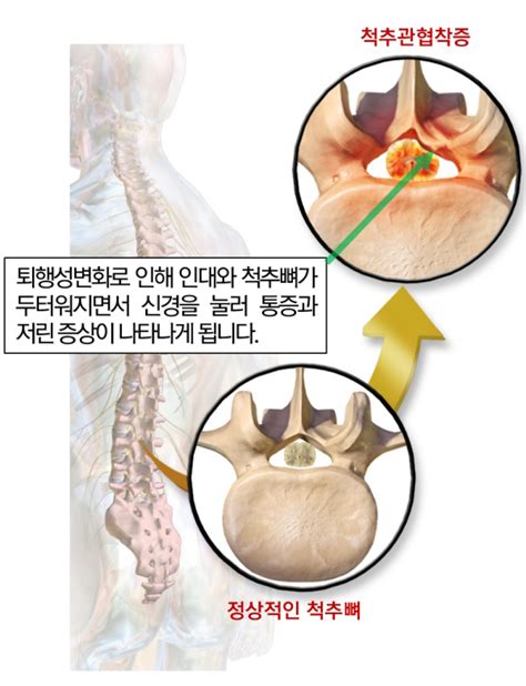 췌장은 우리 몸의 상복부 뒤쪽 깊이 위치하는 기관으로 길이는 약 15cm정도로 작은 바나나 모양입니다. 신강한의원 - 척추·관절·통증 - 몸을 앞으로 숙여야 편해지는 ...