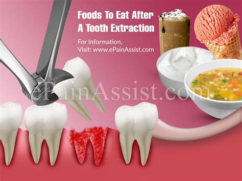 Cold foods may help with some of the discomfort. Foods To Eat After A Tooth Extraction | Food after tooth ...