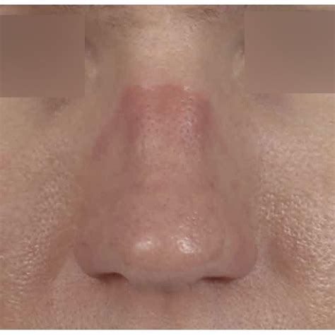 Skin cancer is the most common; Persistent erythema on the bridge of the nose in the ...