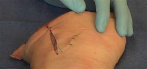 Your risk of infection increases the longer the wound remains open. How to Suture the dog ear of a wound closed « First Aid ...