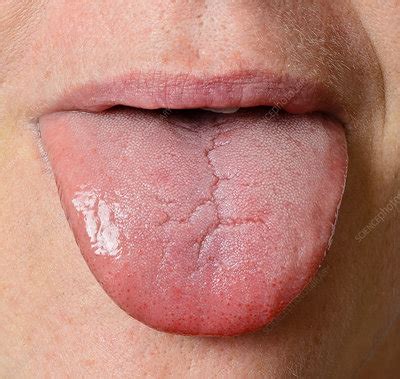The appearance of a white coating is caused by debris, bacteria and dead cells getting lodged between the enlarged and. Human Tongue - Stock Image - C022/0661 - Science Photo Library