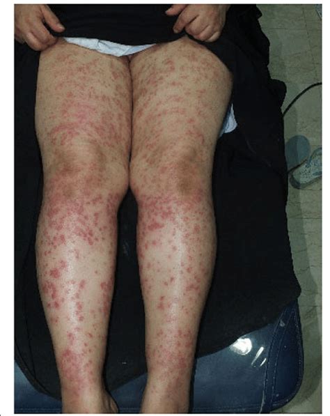 This type of burn can cause the victim to suffer, possibly up to three weeks. Numerous palpable purpura over both thighs and legs after ...