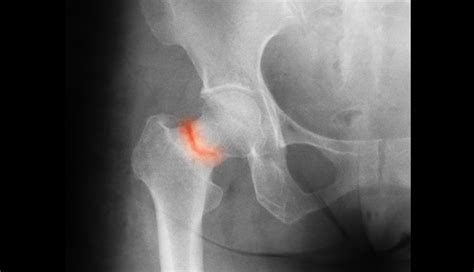 Accuracy of Trabecular Bone Score to Assess Fragility ...