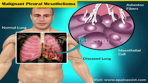 They help victims of asbestos exposure get justice by pursuing legal action against the companies. Mesothelioma Cancer Attorney - YouTube