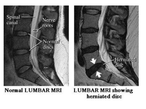 Fungsi pertama untuk cara merawat rambut rusak, seperti dikutip dari ehow: Cara Selamat Atasi Slipped Disc Tanpa Pain Killer Untuk ...