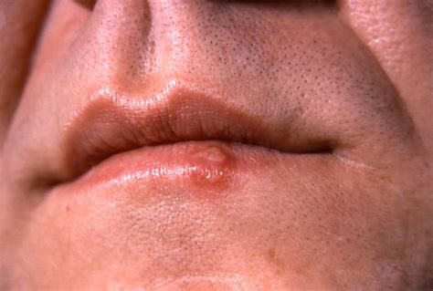 Herpes Labialis. Causes, symptoms, treatment Herpes Labialis
