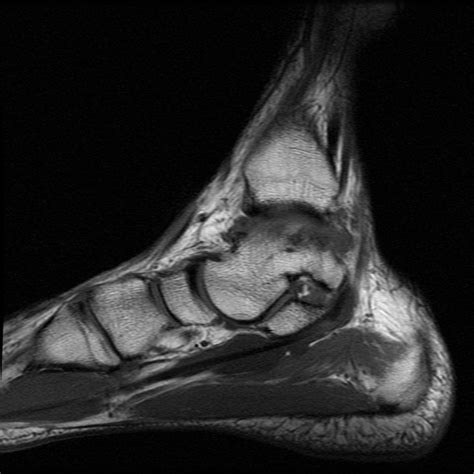 If one or more of the tendons have been damaged, such as being cut for example, they can be repaired surgically. Tenosynovitis of the flexor hallucis longus | Image | Radiopaedia.org