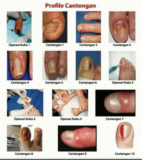 Akan tetapi banyak orang yang menghindar untuk tak dapat dipungkiri, untuk membuat gambar tangan tidaklah mudah. Obat Tetes Cantengan Sakit Kuku Jari Jempol Kaki Tangan Bengkak Canteng Bernanah Berdarah Nyeri ...