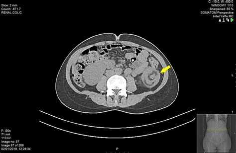 No enlarged mesenteric lymph nodes identified. A rare case of adult colocolonic intussusception of the ...