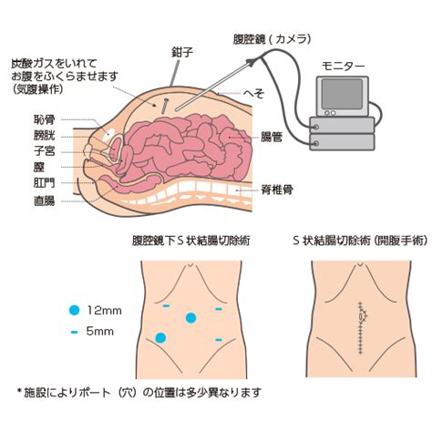 がん研有明病院の症例数 大腸がん手術が年間700例以上、腹腔鏡手術が97％以上 早期大腸がん、大腸ポリープの内視鏡的治療数は年間2900例以上、大腸内視鏡検査は年間8700例以上 大腸がんの多くは「腺腫」という良性の腫瘍が悪性化して発生します。 したがって. 癌 お腹膨らむ - Hello Doctor