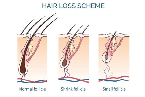 Cbs pittsburgh put the no!no! Azelaic Acid for Hair Loss: Does This Solution Really Work?
