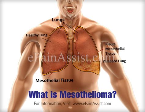 Check spelling or type a new query. What Is Mesothelioma|Causes|Symptoms|Treatment|Diagnosis