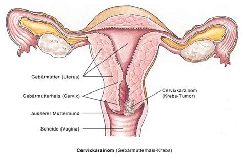 Zum inneren genitale der frau zählen eierstock und eileiter (ovarium und tuba uterina), die jeweils paarig angelegt sind, sowie die gebärmutter (uterus) und die scheide (vagina). Cervixkarzinom, Gebärmutterhalskrebs, Zervixkarzinom ...