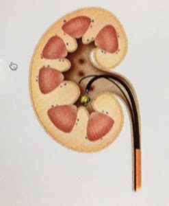 Le calcul rénal peut provoquer des complications de type : Calcul rénal, définition et traitement - Centre d'urologie ...