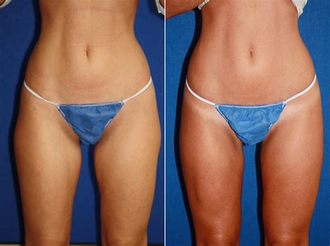 However, no two lasers are the same. Liposuction pictures | Boston, MA | Patient 9057