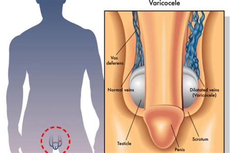 Que manger et comment avoir de grands testicules qui plaisent naturellement? Cancer du testicule : pourquoi les hommes consultent avec ...