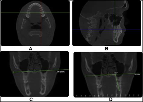 A very rare anatomical variation. Effects of Case Western Reserve University's transverse ...