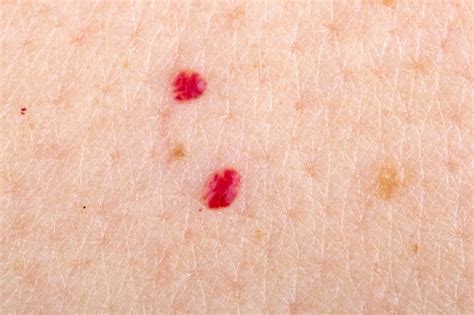 Cherry angiomas are red moles on your skin which contain an abnormal amount of blood vessels. Genetic Drivers Identified in Cherry Angioma - Dermatology Advisor