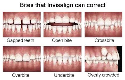 Braces are effective for treating most overbite problems. Invisalign in Yonkers | Invisalign Dentist for Teens & Adults