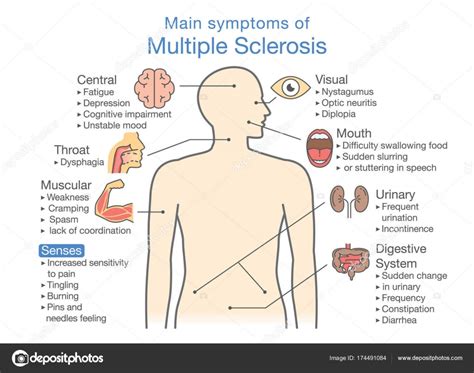 Learn about symptoms, causes and treatment options in the multiple sclerosis condition guide available at u.s. Belangrijkste symptomen van Multiple sclerose ...