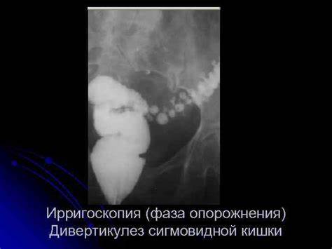 Дивертикулез сигмовидной кишки диеты Лекция Заболевания ободочной кишки Хирургическая анатомия толстой Лекция Заболевания ободочной кишки Хирургическая анатомия толстой Дивертикулез сигмовидной кишки диеты