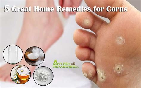 This corn develops from a toe corn removal can be done at home with the use of a pedicure file that you use to file away the. 5 Home Remedies for Corns on Feet, Toes, Hands and Fingers ...