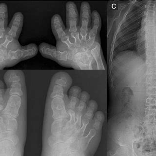 Nasal bridge, underdeveloped ears (railroad track appearance, figure 4), clinodactyly of the fifth fingers (figure 5), camptodactyly, hockey stick findings may include a smooth philtrum, thin upper lip, upturned nose, flat nasal bridge and midface, epicanthal folds, small palpebral fissures, and. Facial features including a broad, depressed nasal bridge ...