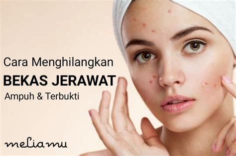 Pokoknya apapun dilakukan deh hanya untuk mendapatkan wajah bersih bebas jerawat. 10 Cara Menghilangkan Bekas Jerawat Secara Alami Dalam 1 ...