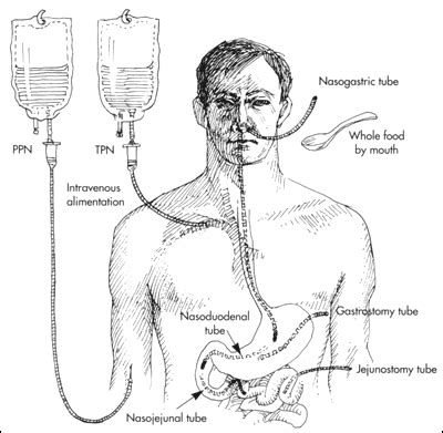 Parenteral nutrition (pn) is the feeding of nutritional products to a person intravenously, bypassing the usual process of eating and digestion. Section 1 - Types of nutrition support