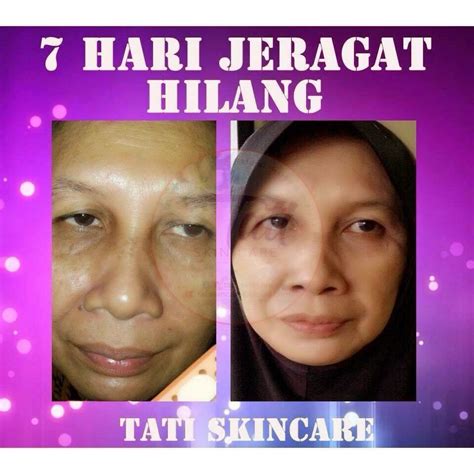 Mempercepatkan proses pencerahan sehingga 3x ganda menghilangkan jerawat dan parut jeragat mengurangkan kedutan menghilangkan jeragat menghalang proses. TATI SKINCARE ORIGINAL MURAH | PEMBEKAL PRODUK KECANTIKAN ...