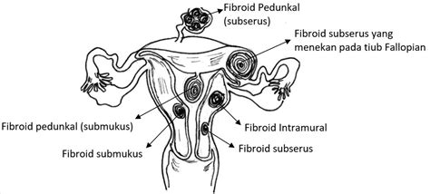 Tumor jinak ini dapat berukuran sangat kecil sehingga tidak bisa dideteksi dengan mata dalam beberapa kasus, fibroid yang muncul selama kehamilan dapat menyusut atau hilang setelah masa kehamilan. Uterine Fibroid - PORTAL MyHEALTH