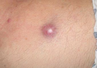 Merkel cell carcinoma (mcc) is a rare type of skin cancer. Q&A with Dr. Paul Nghiem - The Skin Cancer Foundation