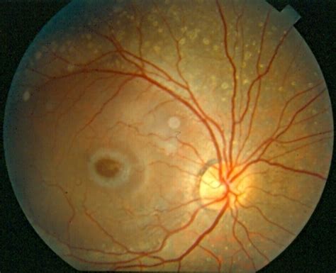 In people with this condition, abnormal lipid. Niemann Pick Disease Type B - Retina Image Bank