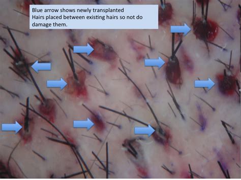 The team at nedia hair loss salon & spa (hair loss specialists) works with every customer to determine the cause of the problem and to create a hair. Hair Transplantation for Early Hair Thinning: Things to ...