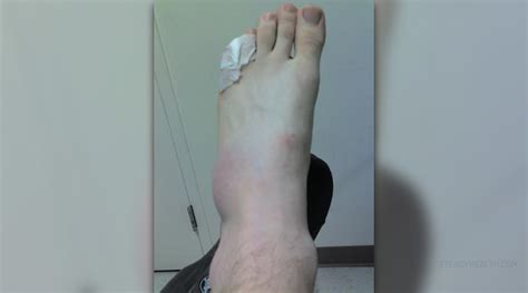 See more of overlapping pinky toes on facebook. Broken pinky toe | General center | SteadyHealth.com