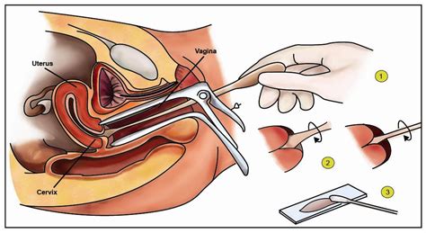 Pap smears, which were introduced in the 1940s, are subjective and not always reliable. Cervical Smear & Cervical Cancer Prevention - Pitter Patter