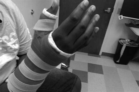 Other additional symptoms that may also occur include: How To Tell If Your Thumb Is Broken Or Sprained