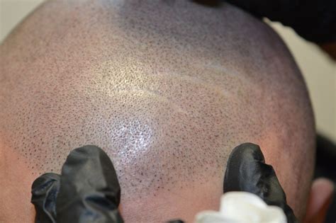 Scalp Guru on Twitter: "Bald? Forget hair loss for good ...